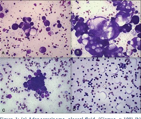 Figure 1 from Pleural effusion: Role of pleural fluid cytology ...