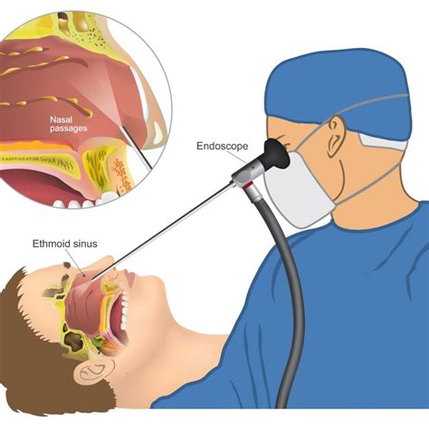 Sinus Surgery - Doxtreat