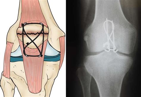 Patellar (Kneecap) Fractures - New Mexico Orthopaedic Associates