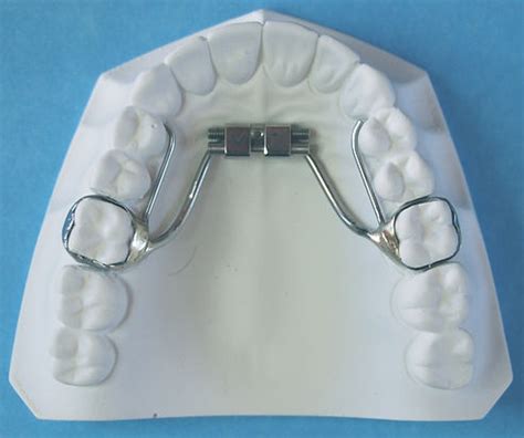 Palatal Expanders | Marlboro, NJ | TG Orthodontics