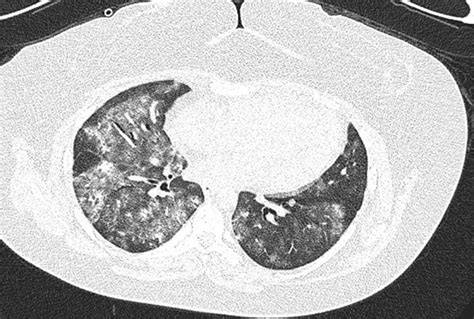 Diffuse Alveolar Hemorrhage - Pulmonary Disorders - Merck Manuals ...