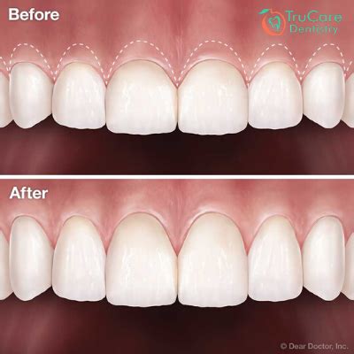 Gum Surgery: Types & What to expect – TruCare Dentistry