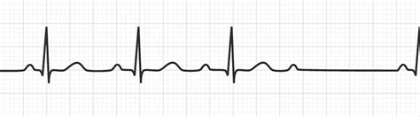 Atrioventricular (AV) Block | Bradyarrhythmias - MedSchool