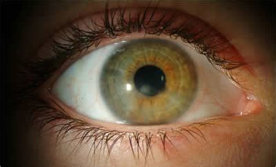 Phlyctenular Keratoconjunctivitis. EyeRounds.org - Ophthalmology - The ...