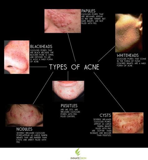 Types Of Acne Scars : Types of Acne Scars and How to Treat Them ...