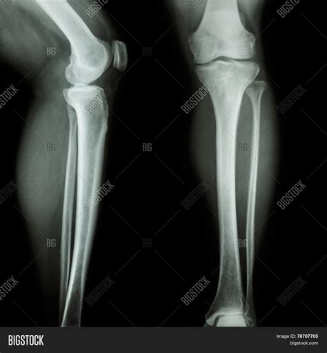 Film X-ray Leg & Knee Image & Photo (Free Trial) | Bigstock