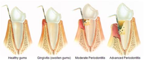 Save Teeth – Central Periodontics & Implants