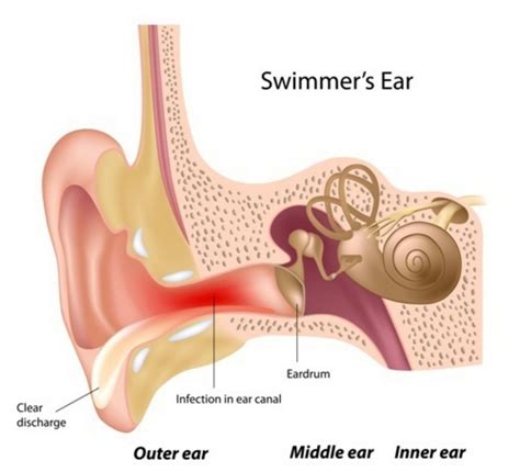 What is Otitis Externa (Swimmers Ear)? (Symptoms, Causes, and Treatment ...