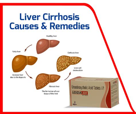 Liver Cirrhosis - Causes & Treatments | Medicine Manufacturing - SHIRR