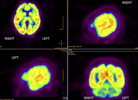 PET Scan for Lung Cancer: Uses, Procedure, Results