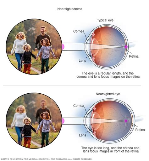 What Makes A Person Near Sighted