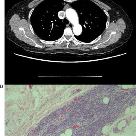 (a) Anterior mediastinal nodule compatible with a small thymoma (arrow ...