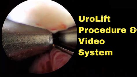 Narrated UroLift Procedure Video as shown using Redfin R3800 Digital ...