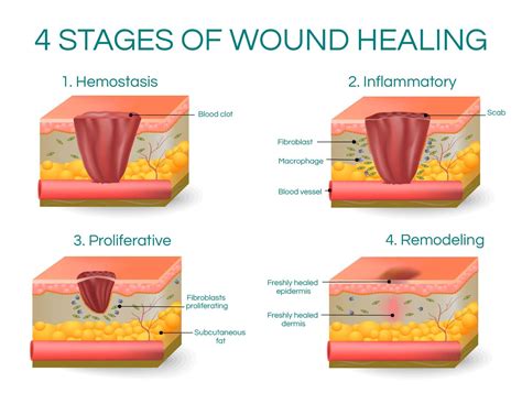 4 Stages of Wound Healing | Wound healing, Heal wounds faster, Healing