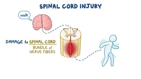 Spinal Cord Injury and Spinal Cord Tumors - Osmosis Video Library