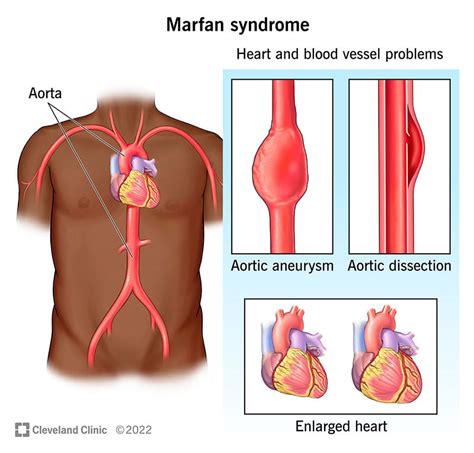 Marfan Syndrome: Causes, Symptoms, Diagnosis & Treatments