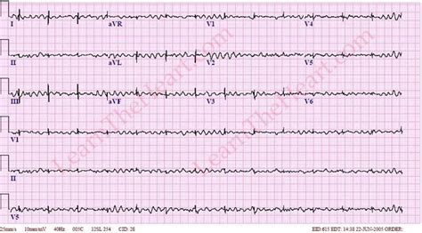 Ventricular Fibrillation (Example) | Learn the Heart