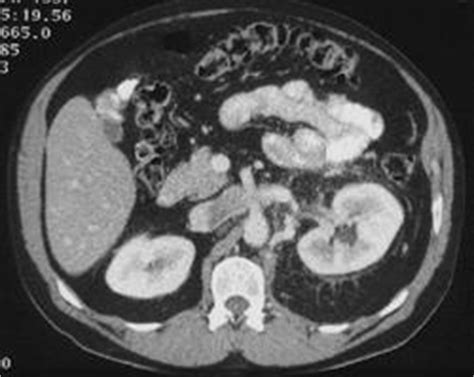 Oncocytoma - Kidney Case Studies - CTisus CT Scanning