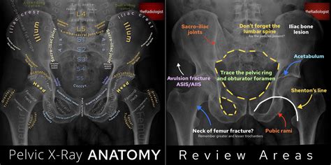 Understanding The Importance Of Pelvis X-Ray Lines In Medical Diagnosis ...