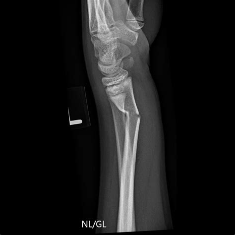 Greenstick Fracture Treatment