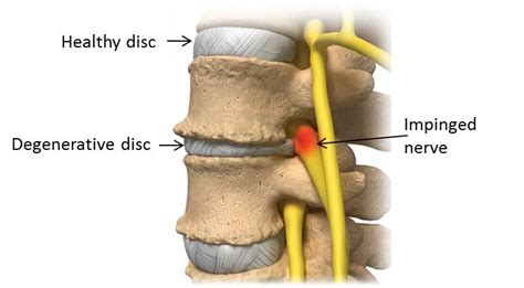 Degenerative Disc Disease and Lower Back Pain