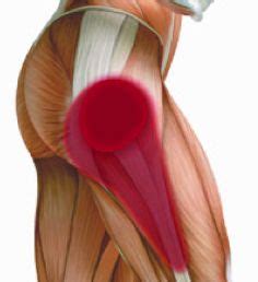 Trochanteric Bursitis Causes, Symptoms, Diagnosis and Treatment ...