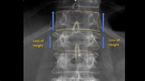 Lumbar Fracture X Ray