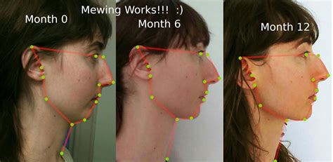 Mewing Works!!! 23 year old woman's 1 year results, Nose breathing ...