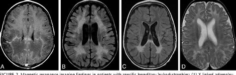 Leukodystrophies: Classification, Diagnosis, and Treatment | Semantic ...