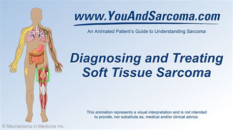 Understanding Soft Tissue Sarcoma