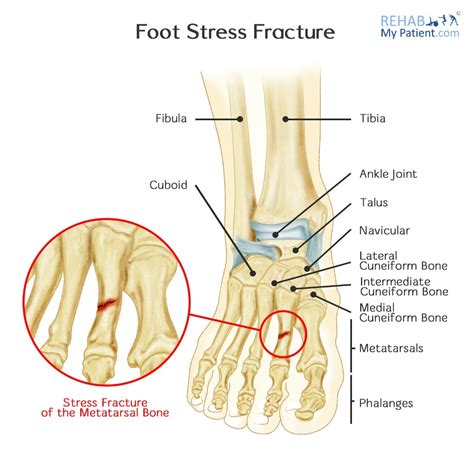 Foot Stress Fracture | Rehab My Patient