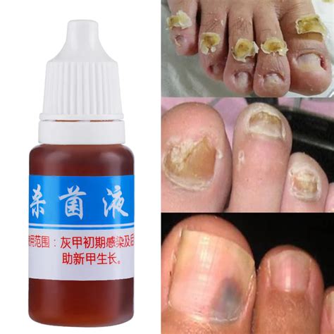 10ml Nail Fungus Treatment Cream Onychomycosis Paronychia Anti Fungal ...