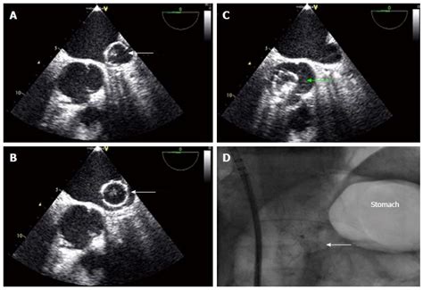 Percutaneous left atrial appendage closure: Technical aspects and ...