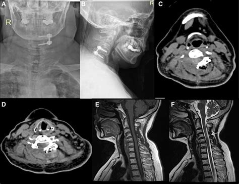 Postoperative images of the cervical spine of a 60-yr-old female ...