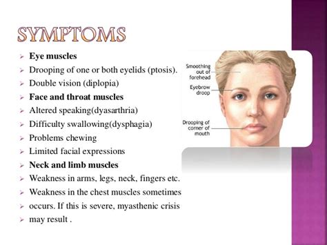 MYO Therapy & Healthcare Institute: Myasthenia gravis(MG)