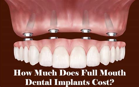 How Much Does Full Dental Implants Cost - Dental News Network