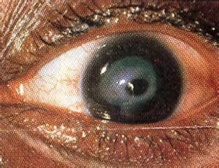 Health Informations-G. P. Baskaran.: Corneal xerosis / ulceration