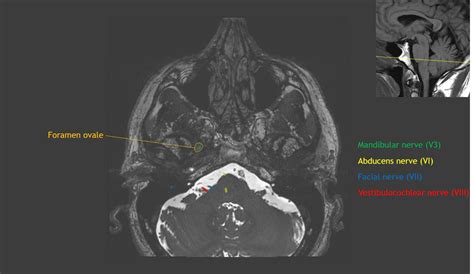 Vestibular Nerve Mri