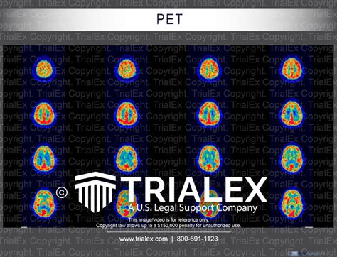 PET Scans of a Brain - TrialExhibits Inc.