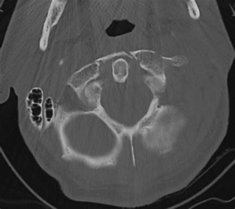 Unstable C-Spine Fractures