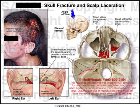 Skull Fracture and Scalp Laceration - 204399_03X