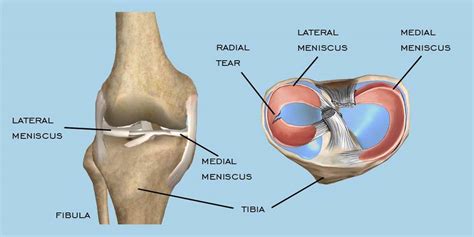 Prevention & Treatment Of Meniscal Cyst - Write For Us Fashion