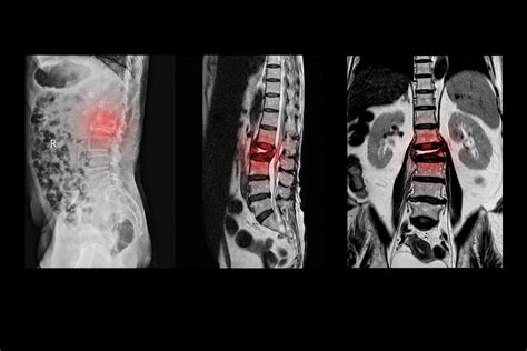 Lumbar Laminectomy Surgery to Cure Spinal Stenosis - Premia Spine