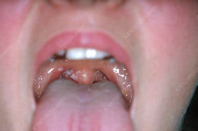 Oral Thrush - Stock Image - C014/4393 - Science Photo Library