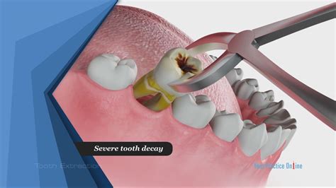 Tooth Extraction Video | Medical Video Library