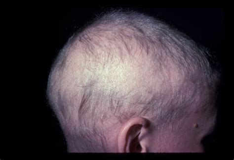 Alopecia Totalis: Causes. Symptoms, & Treatment - Wimpole Clinic