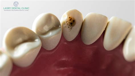 Do You Have Tooth Decay? 5 Signs You Need To See a Dentist