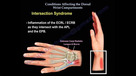 Conditions Affecting Dorsal Wrist Compartments - Everything You Need To ...