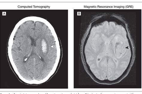 Table 1 from Comparison of MRI and CT for detection of acute ...