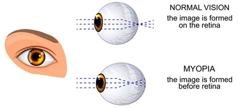 Visual Problems - Medirex Opticians